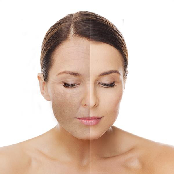 Skin resurfacing - Laser Clinic Galway