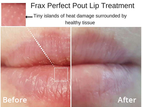 Natural lip enhancement before and after at Laser Clinic Galway