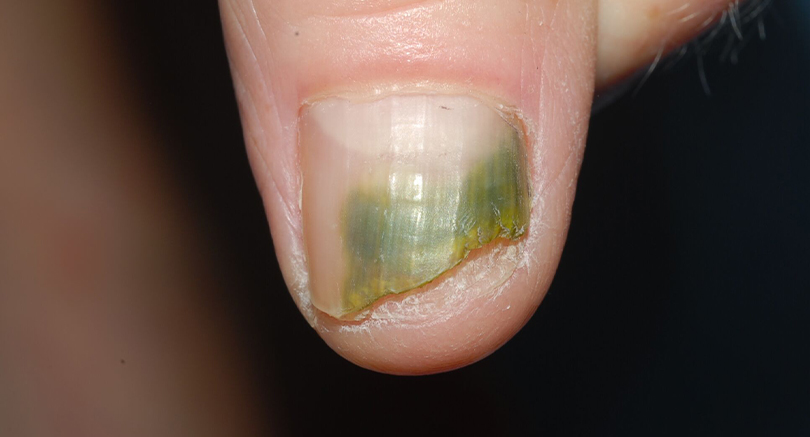 thumbnail image 2 of Magic Hongo Antifungal Nail Support - Natural Liquid For Toe & Finger Fungus (Made In USA) 2 of 3