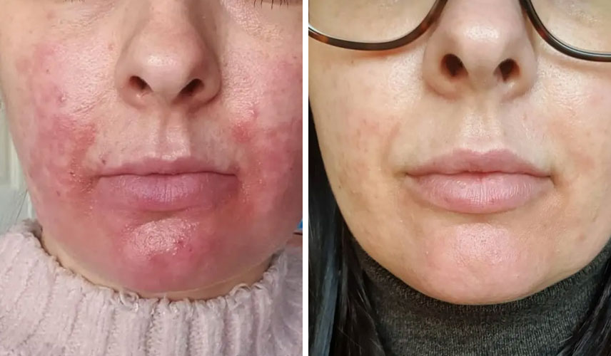 Dermalux-before-after-2