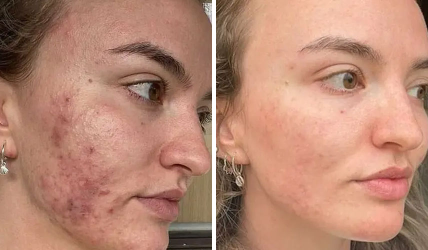 Dermalux-before-after