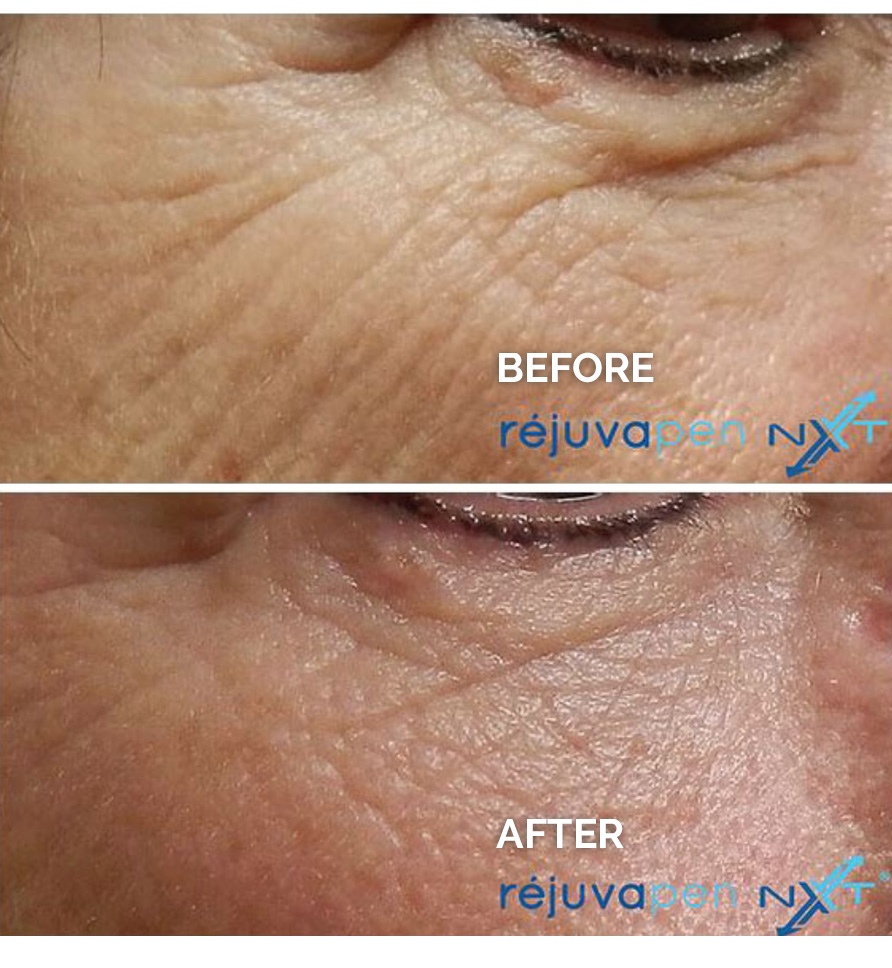 Rejuvapen-NTX-before-and-after-1