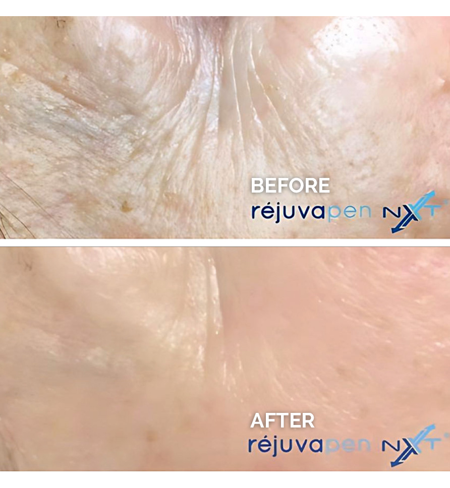 Rejuvapen-NTX-before-and-after-2